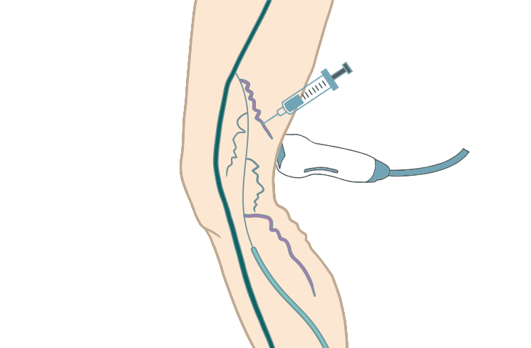 ULTRASOUND GUIDED SCLEROTHERAPY